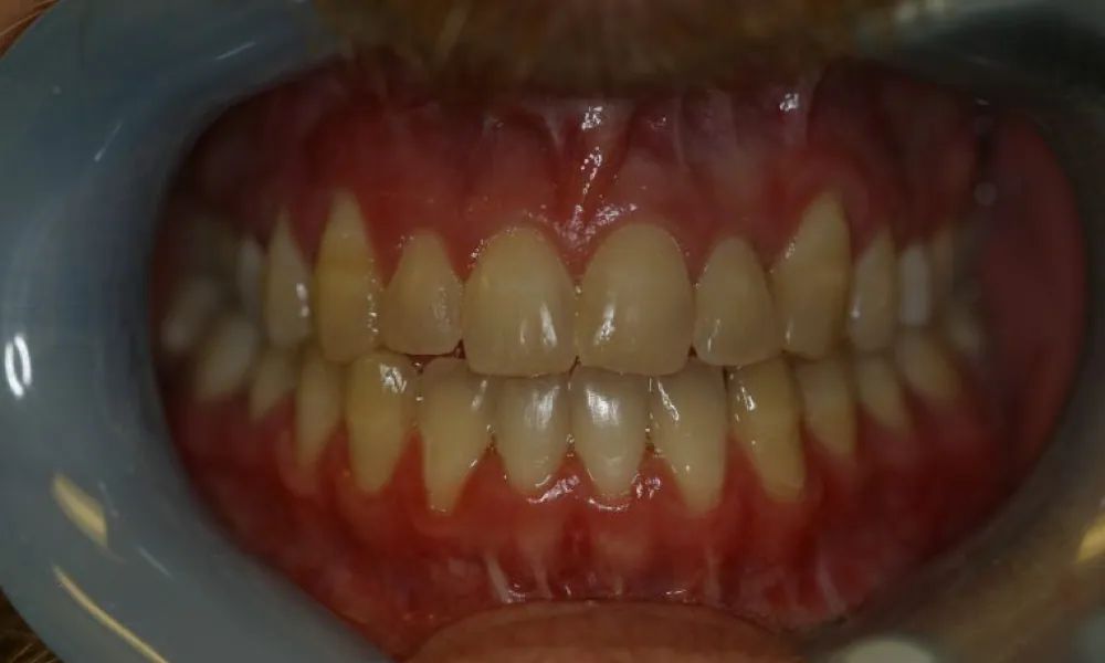 Clinical photo from Joe's corrective jaw surgery case